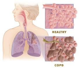 Lung detox Copd vs healthy lung